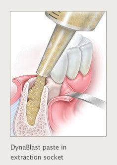 DynaBlast ペースト 1.0cc