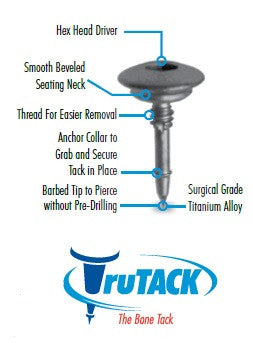 ボーン タック TruTACK 5mm Bone Tack (チタン製)