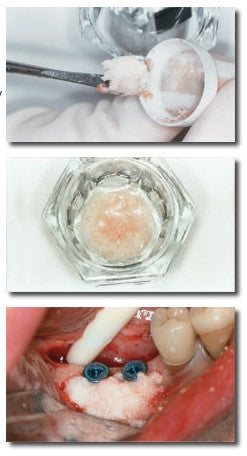 Bone Collector (10個入り) (BC100)