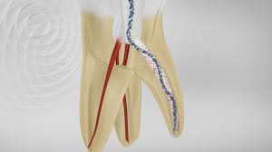 Brasseler XP - 3D Shaper, 21mm 青