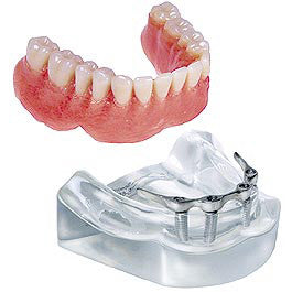 Model - Bar OverDenture W / 4 Implants