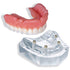 4 Implant Locator Abutment Upper Overdenture Model