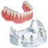 4 Implant Locator Abutment Lower Overdenture Model