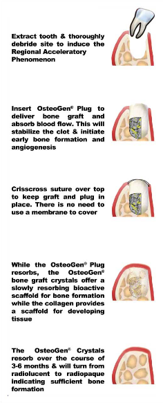 オステオ ゲン プラグ OsteoGen Plug Large 10 x 20mm (5個入り)