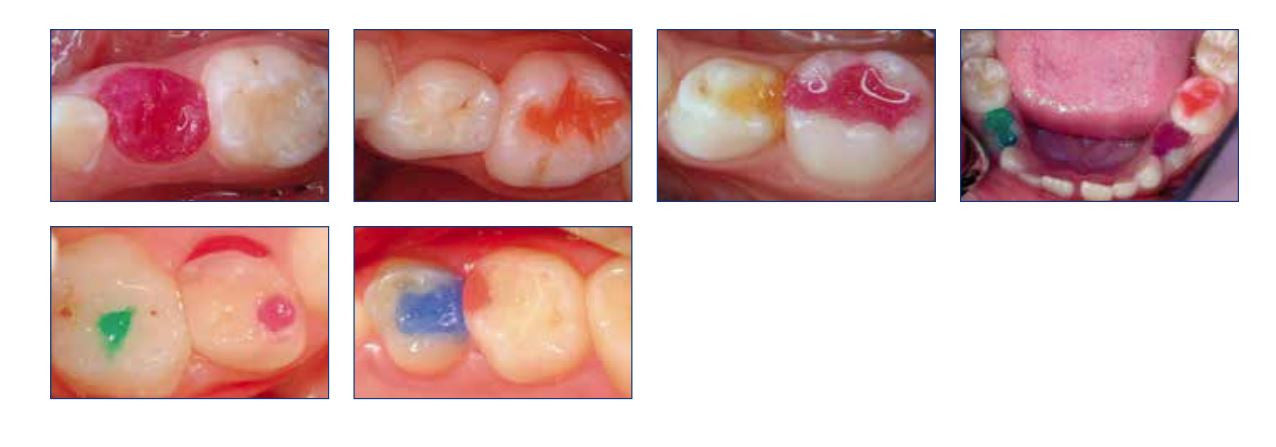 Twinky Star 乳歯用充填剤 コンポジット レジン カプセル アソート セット