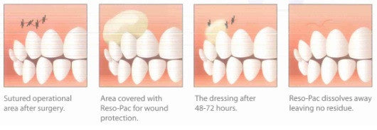 Reso - Pac Hydrophilic Periodontal Dressing (ペリオ ドレッシング)