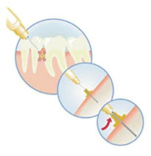 X - Tip Intraosseous Anesthetic Delivery System 骨内麻酔用注射針